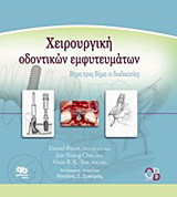 Χειρουργική οδοντικών εμφυτευμάτων: Βήμα προς βήμα οι διαδικασίες